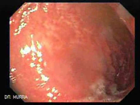 Gastric Cicatrization With Pylorus Stenosis (20 of 23)