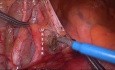 Laparoscopic Abdominoperineal Resection