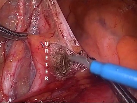 Laparoscopic Abdominoperineal Resection