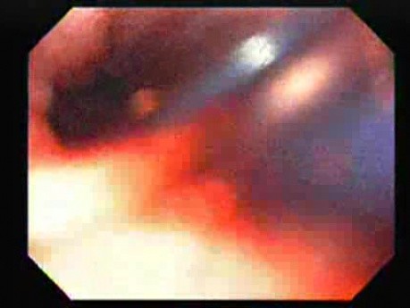 Quick Look at the Esophageal Mucosa After Dilation