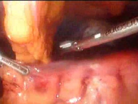 Gastrointestinal Stromal Tumor - GIST (18 of 65)