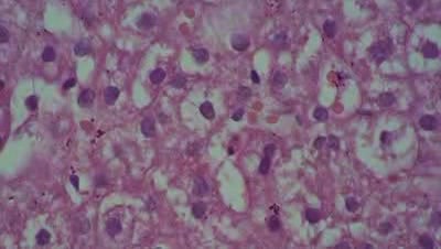 Hepatitis C