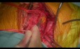 Left Atrial Myxoma Embolism to the Descending Abdominal Aorta Bifurcation 