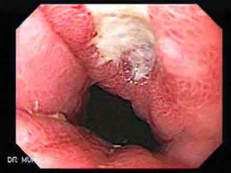 Hourglass Stomach - Control Endoscopy, Signs of Recovery