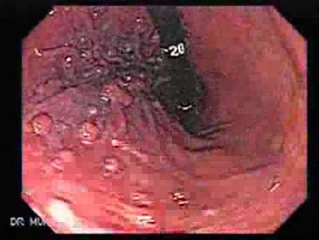 Hyperplastic Gastric Polyposis - Endoscopy (3 of 6)