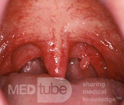 Pathologies of the Mouth