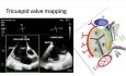 Introduction to 3D Echocardiography Part 2: Mitral, Tricuspid, Aortic, ASD,﻿ and LAA Assessment