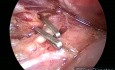 Laparoscopic Cholecystectomy in Early Post Partum Acute Pancreatitis