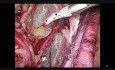 Endometrial cancer