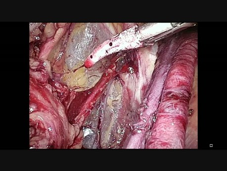 Endometrial cancer