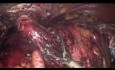 LPS Degastro-Gastrectomy