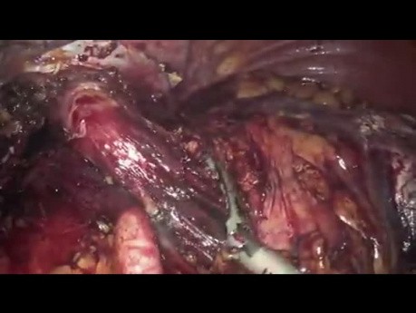 LPS Degastro-Gastrectomy