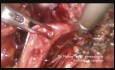 Bilateral Endometriosic Utero Sacral Nodules Resection 
