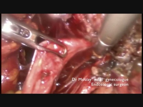 Bilateral Endometriosic Utero Sacral Nodules Resection 