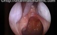 Right Inferior Meatal Antrostomy with Antral Polyps