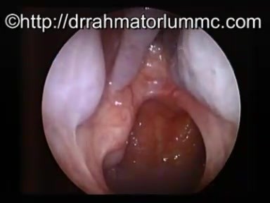 Right Inferior Meatal Antrostomy with Antral Polyps