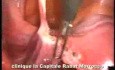 Laparoscopic Treatment Of Uterine Retroversion In Case Of Chronic Pelvic Pain