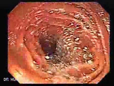 Enteroscopy(2 of 2)