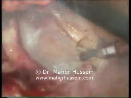 L Low Anterior Colon Resection - Laparoscopic Approach