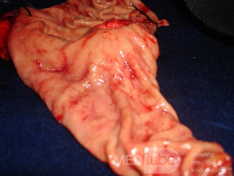 Diffuse Adenocarcinoma with signet ring cells (11 of 18)