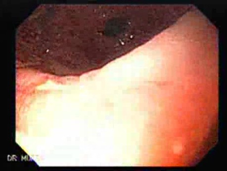 Primary Gastric Lymphoma Following Kidney Transplantation - Display of the Ulcers