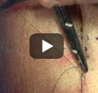 Surgical Suturing