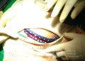 Acute Spontaneous Subdural Hemorrhage in the Subdural Space