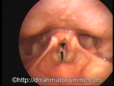 Arytenoid Mass