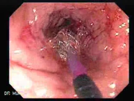 Colonoscopy with Dilation (2 of 8)