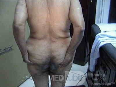 Extensive Acanthosis Nigricans due to rectal carcinoma (3 of 7)