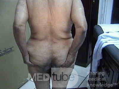 Extensive Acanthosis Nigricans due to rectal carcinoma (3 of 7)