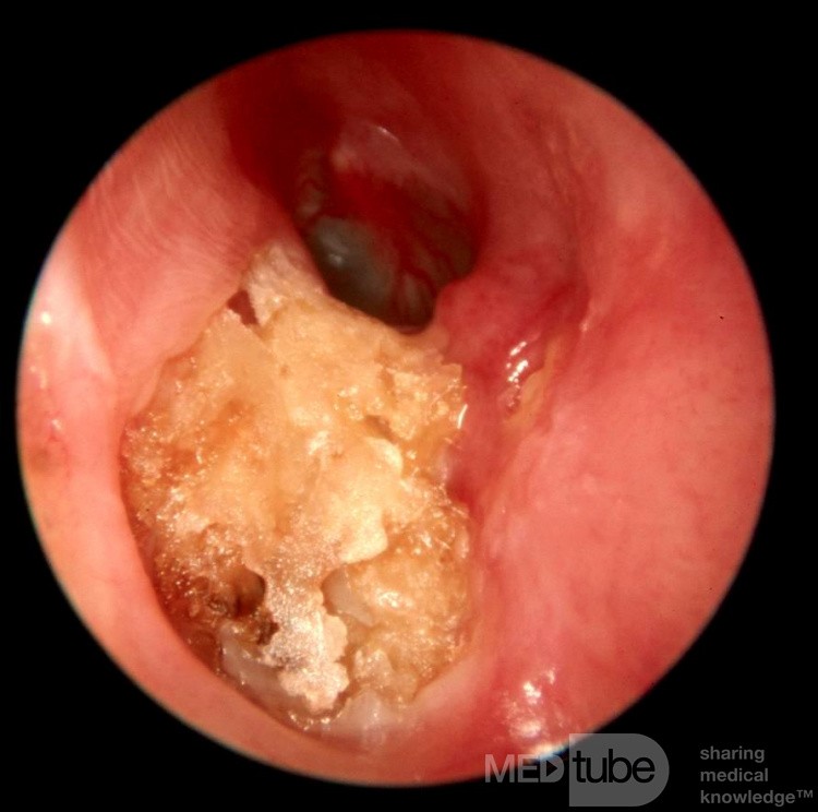 Idiopathic Osteitis Tympanic Bone