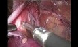 E Tep Repair of Incarcerated Inguinal Hernia