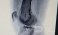 ACL Reconstruction (2/2)