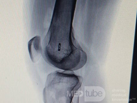ACL Reconstruction (2/2)