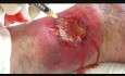 PRP (Platelet-Rich Plasma) - Treatment of Ulceration