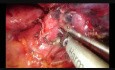 Uniportal VATS Left Upper Lobectomy and Chest Wall Resection