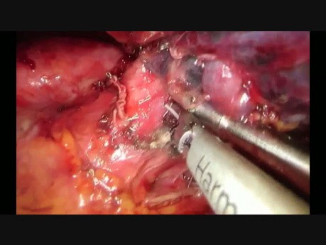 Uniportal VATS Left Upper Lobectomy and Chest Wall Resection