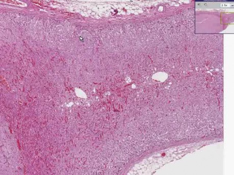 Adrenal - Cortical Adenoma