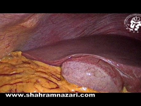 Accessory Liver Tissue on the Gallbladder