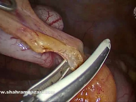 Laparoscopic Appendectomy for Acute Appendicitis