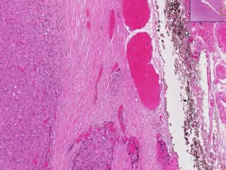 Follicular carcinoma