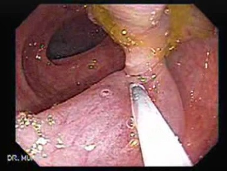 Colonoscopic Polypectomy (7 of 18)