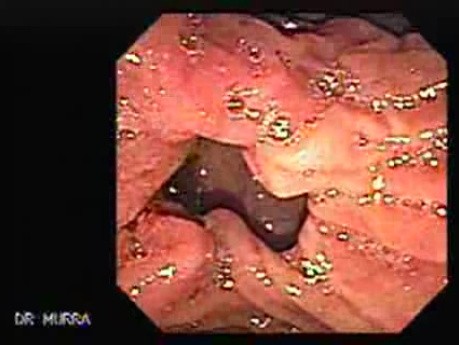 Cholangiocarcinoma (3 of 4)
