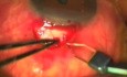 Fugo blade as Atwal balanced approach (ABA) for glaucoma - part I