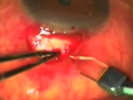 Fugo blade as Atwal balanced approach (ABA) for glaucoma - part I