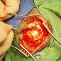 Epicranial Tumor Injury
