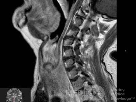 Esophageal Squamous Cell Carcinoma of the the upper third of the Esophagus that invades the subglotic (7 of 8)