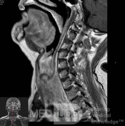 Esophageal Squamous Cell Carcinoma of the the upper third of the Esophagus that invades the subglotic (7 of 8)