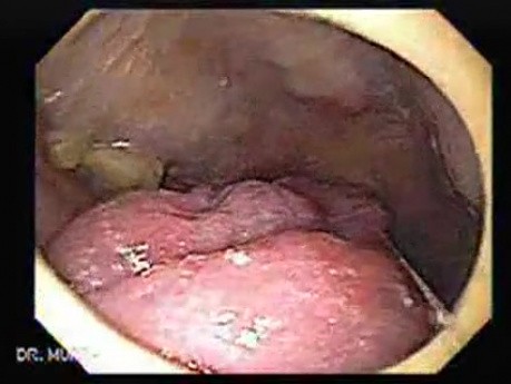 Squamous cell carcinoma of the tongue (2 of 3)